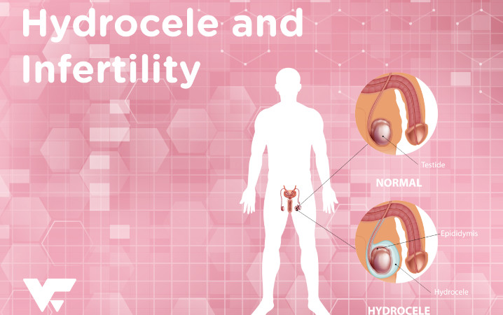 Hydrocele and Infertility